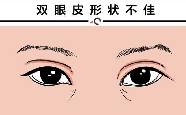 上海陈芝双眼皮多少钱
