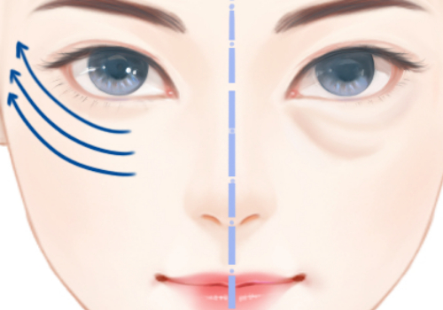 常州眼袋手术多少钱