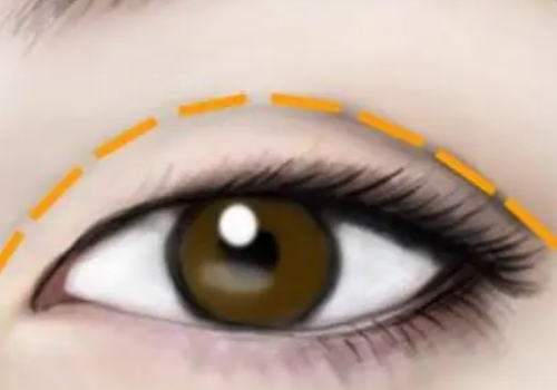 贵阳美莱双眼皮多少钱