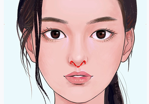 宝鸡隆鼻一般多少钱