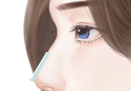 上海千美隆鼻多少钱