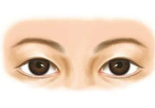 沈阳美莱做双眼皮多少钱
