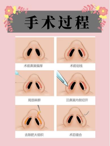 上海九院韦敏团队鼻综合多少钱