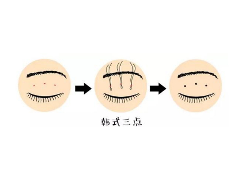 潍坊坤娜双眼皮多少钱