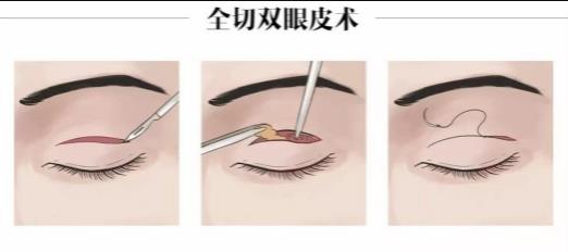 珠海艾贝尔双眼皮多少钱