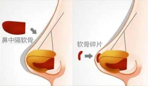 肋软骨隆鼻多少钱