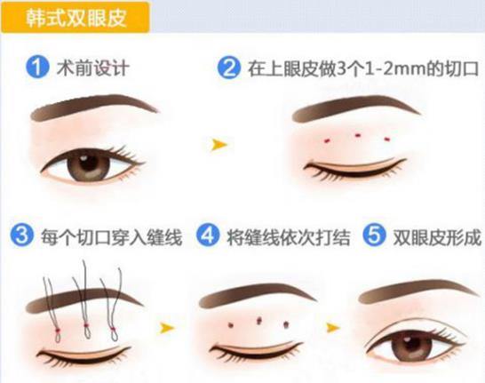 北京金奇龙双眼皮多少钱