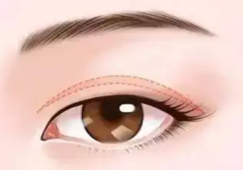 咸阳眼袋手术多少钱