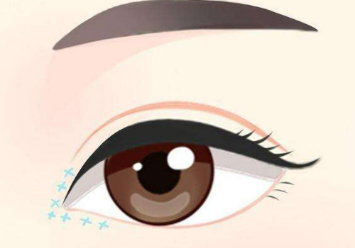 咸阳眼袋手术多少钱