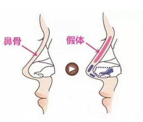 南京施尔美隆鼻多少钱