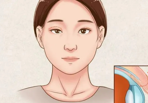 曙光做双眼皮多少钱