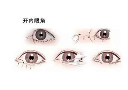 吉林市开眼角双眼皮多少钱