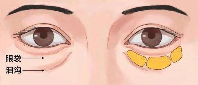 常州一院做眼袋手术多少钱