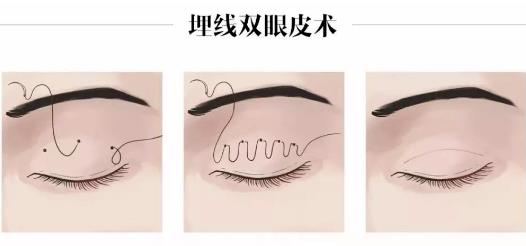 无锡八院割双眼皮多少钱
