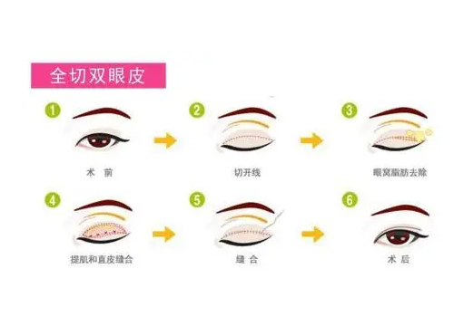 邯郸三医院能做双眼皮吗多少钱