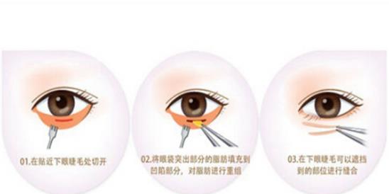 乐清人民医院去眼袋多少钱