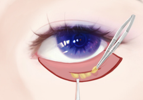 北京八大处医院眼袋多少钱