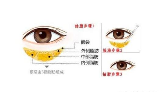 汉中中心医院去眼袋多少钱