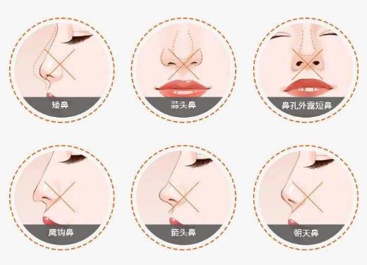 深圳阳光隆鼻多少钱