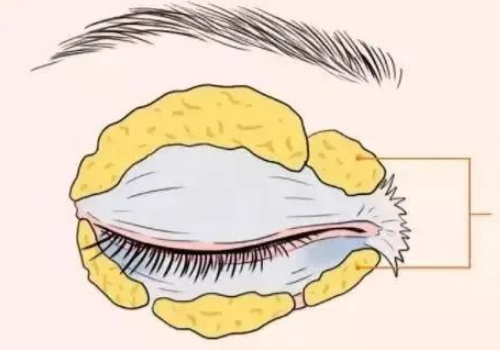 哈尔滨雅美修复双眼皮多少钱